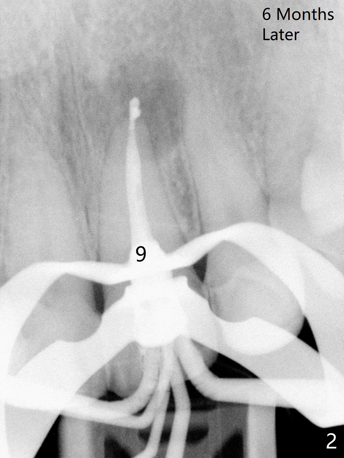 Leak Of CaOH Paste From Apical Foramen Of Upper Lateral Incisor Duluth Atlanta Georgia